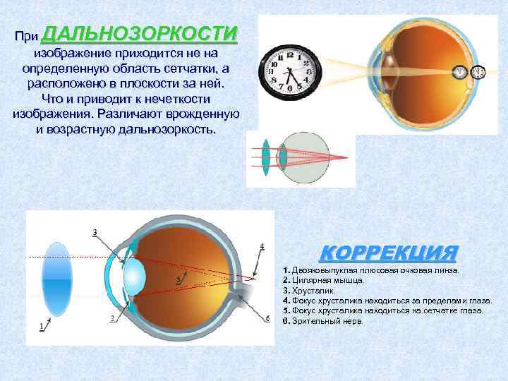 При ДАЛЬНОЗОРКОСТИ изображение приходится не на определенную область сетчатки, а расположено в плоскости за