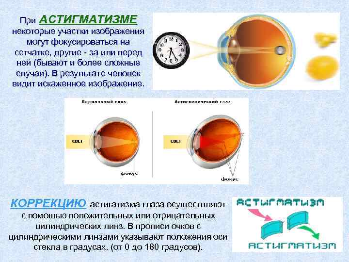 При АСТИГМАТИЗМЕ некоторые участки изображения могут фокусироваться на сетчатке, другие - за или перед