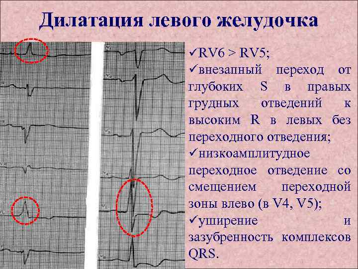 Дилатация левого желудочка üRV 6 > RV 5; üвнезапный переход от глубоких S в