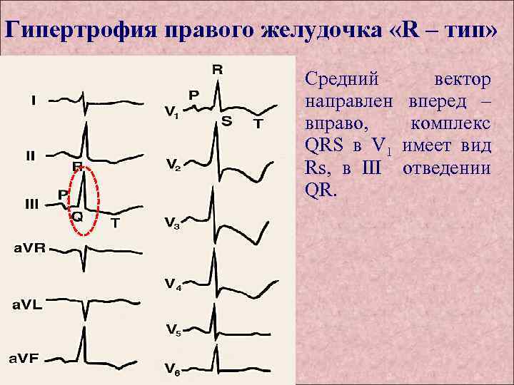 Гипертрофия правого отдела