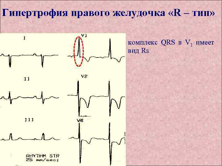 Гипертрофия правого желудочка «R – тип» комплекс QRS в V 1 имеет вид Rs