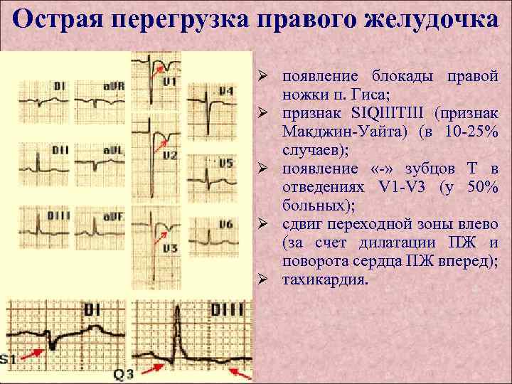 Острая перегрузка правого желудочка Ø появление блокады правой Ø Ø ножки п. Гиса; признак