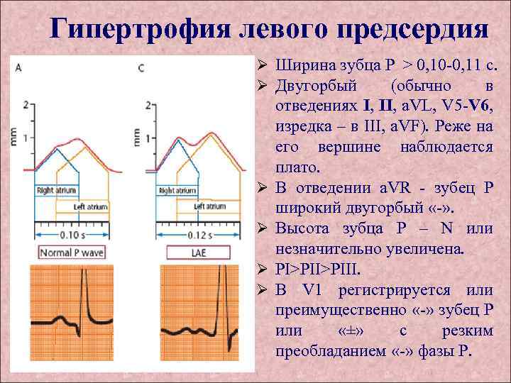 Гипертрофия левого предсердия Ø Ширина зубца P > 0, 10 -0, 11 с. Ø