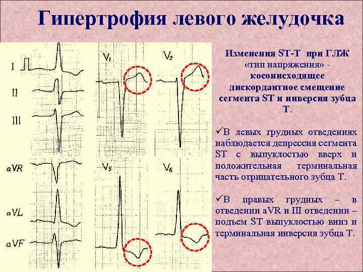 Гипертрофия левого желудочка Изменения ST-T при ГЛЖ «тип напряжения» косонисходящее дискордантное смещение сегмента ST