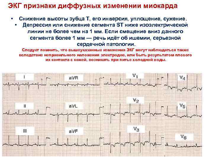 ЭКГ признаки диффузных изменении миокарда • Снижение высоты зубца Т, его инверсия, уплощение, сужение.