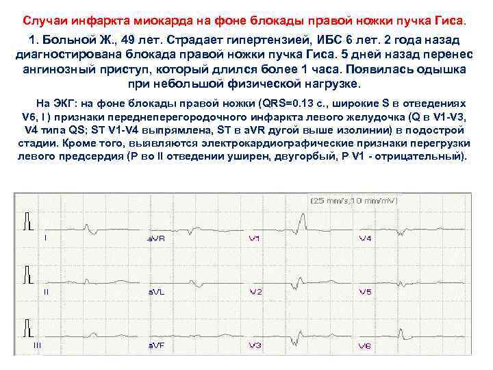 Случаи инфаркта миокарда на фоне блокады правой ножки пучка Гиса. 1. Больной Ж. ,