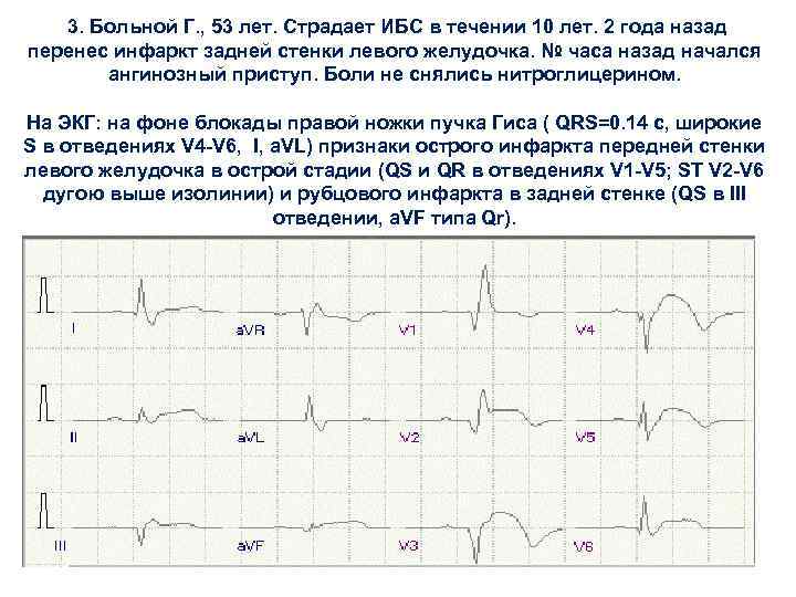  3. Больной Г. , 53 лет. Страдает ИБС в течении 10 лет. 2