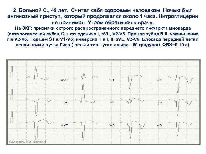 2. Больной С. , 49 лет. Считал себя здоровым человеком. Ночью был ангинозный приступ,