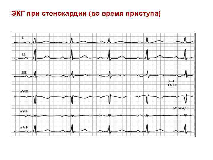 ЭКГ при стенокардии (во время приступа) 