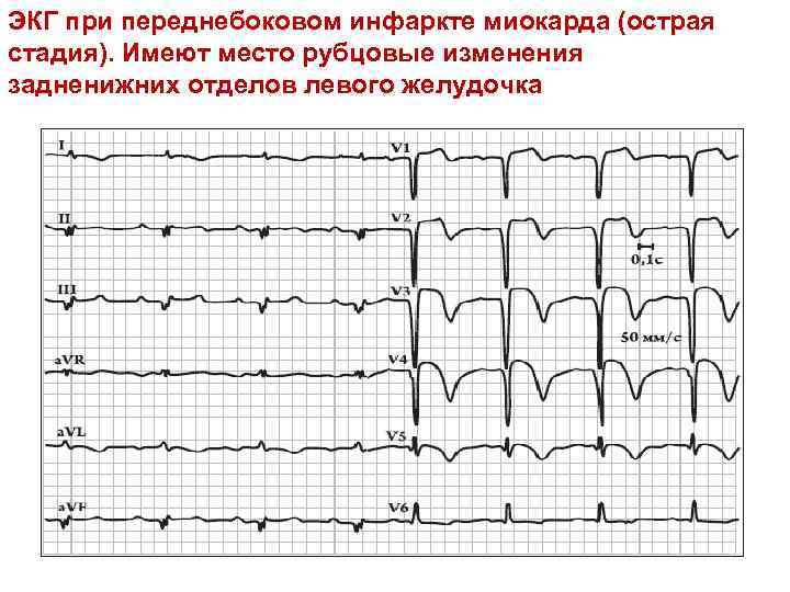 ЭКГ при переднебоковом инфаркте миокарда (острая стадия). Имеют место рубцовые изменения задненижних отделов левого