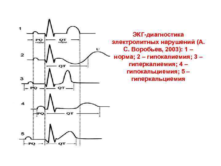ЭКГ-диагностика электролитных нарушений (А. С. Воробьев, 2003): 1 – норма; 2 – гипокалиемия; 3