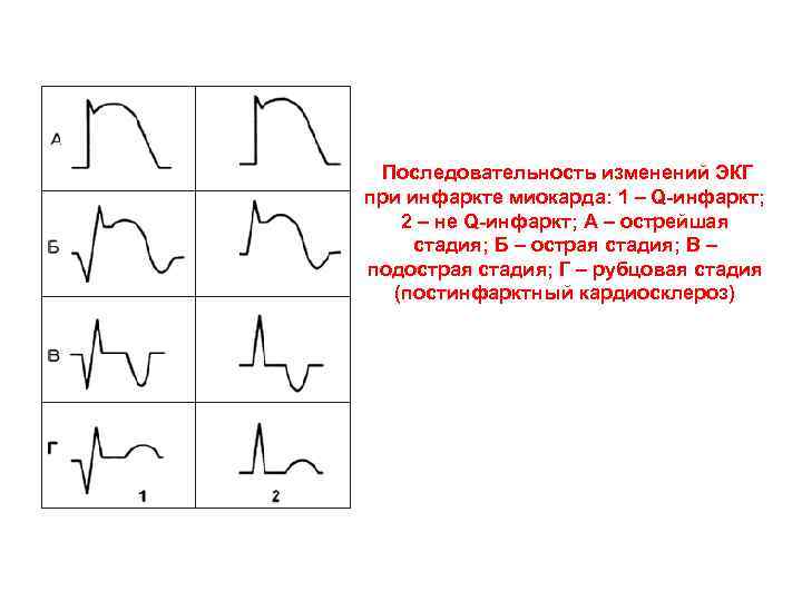  Последовательность изменений ЭКГ при инфаркте миокарда: 1 – Q-инфаркт; 2 – не Q-инфаркт;