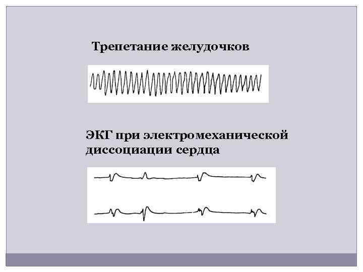 Трепетание желудочков ЭКГ при электромеханической диссоциации сердца 