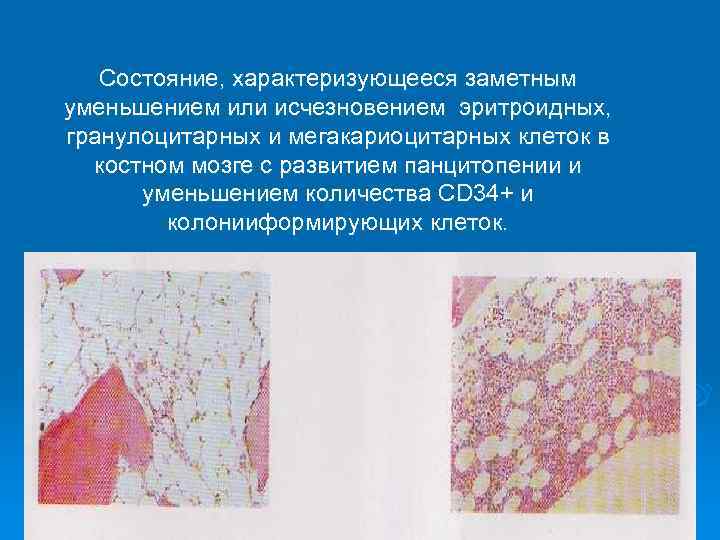 Состояние, характеризующееся заметным уменьшением или исчезновением эритроидных, гранулоцитарных и мегакариоцитарных клеток в костном мозге