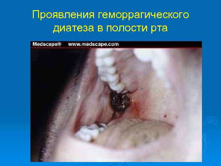 Проявления геморрагического диатеза в полости рта 