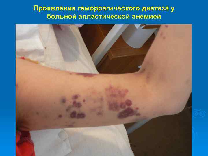 Проявления геморрагического диатеза у больной апластической анемией 