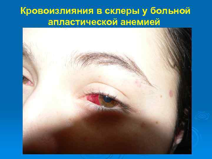 Кровоизлияния в склеры у больной апластической анемией 