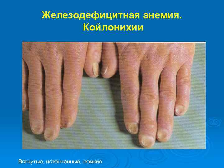 Железодефицитная анемия. Койлонихии Вогнутые, истонченные, ломкие 