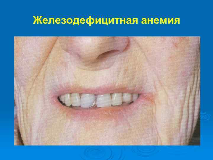 Железодефицитная анемия 