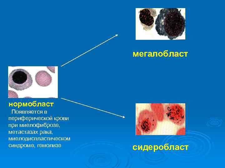 Нормобласты в крови картинки