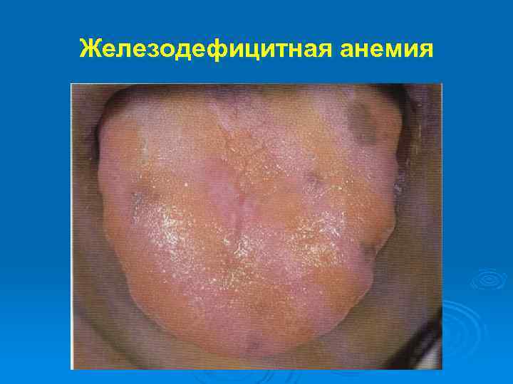Железодефицитная анемия 