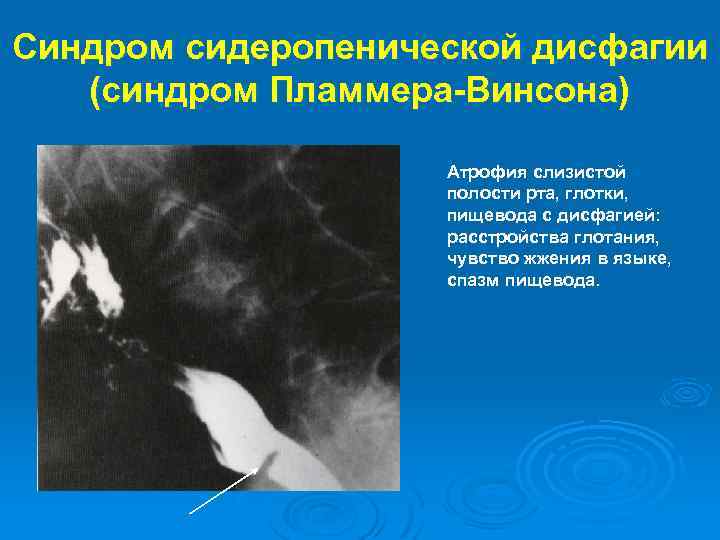 Синдром сидеропенической дисфагии (синдром Пламмера-Винсона) Атрофия слизистой полости рта, глотки, пищевода с дисфагией: расстройства