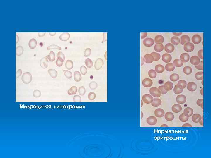 Микроцитоз, гипохромия Нормальные эритроциты 