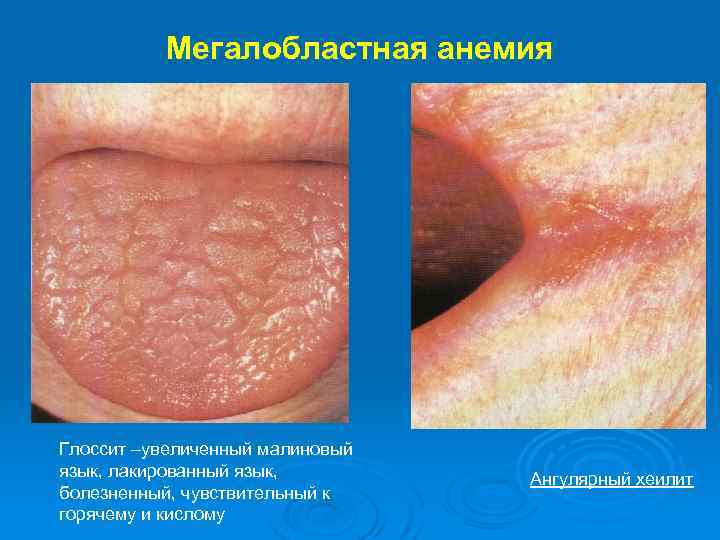 Мегалобластная анемия Глоссит –увеличенный малиновый язык, лакированный язык, болезненный, чувствительный к горячему и кислому