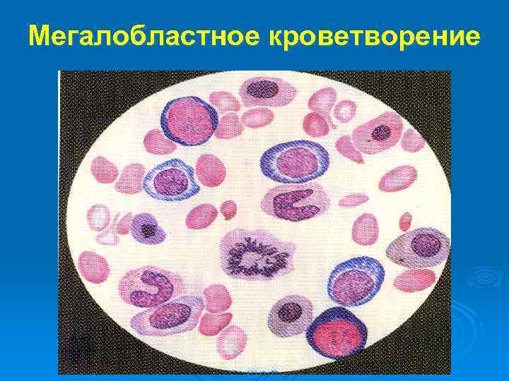 Мегалобластное кроветворение 