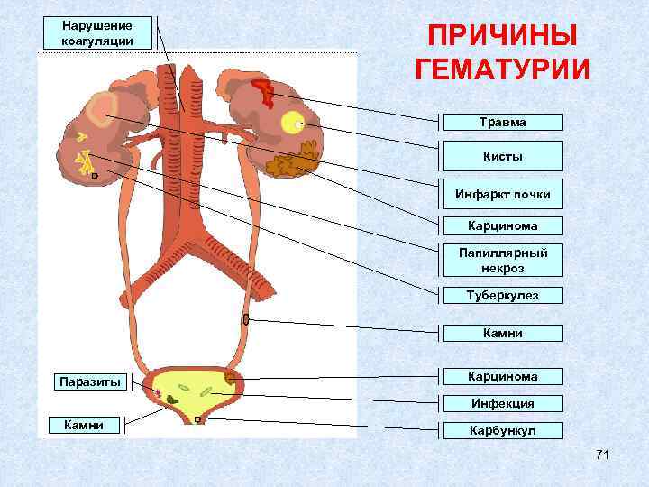 Нарушение коагуляции ПРИЧИНЫ ГЕМАТУРИИ Травма Кисты Инфаркт почки Карцинома Папиллярный некроз Туберкулез Камни Паразиты