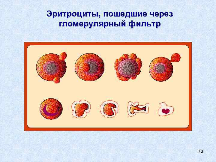 Эритроциты, пошедшие через гломерулярный фильтр 73 