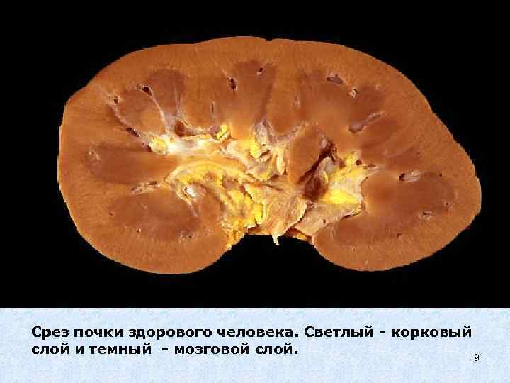 Срез почки здорового человека. Светлый - корковый слой и темный - мозговой слой. 9