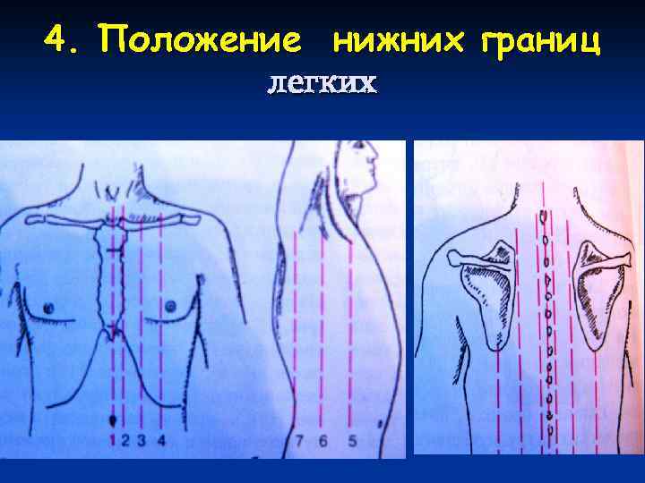 4. Положение нижних границ легких 