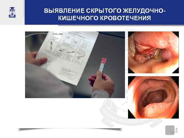 ВЫЯВЛЕНИЕ СКРЫТОГО ЖЕЛУДОЧНОКИШЕЧНОГО КРОВОТЕЧЕНИЯ 12 