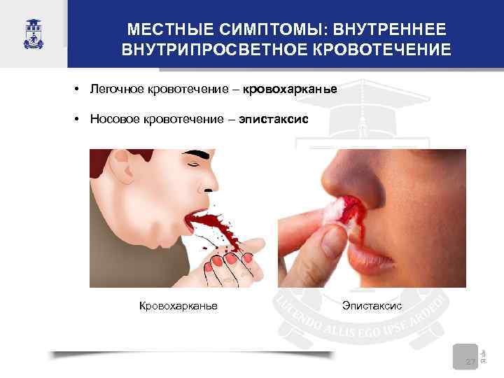 МЕСТНЫЕ СИМПТОМЫ: ВНУТРЕННЕЕ ВНУТРИПРОСВЕТНОЕ КРОВОТЕЧЕНИЕ • Легочное кровотечение – кровохарканье • Носовое кровотечение –