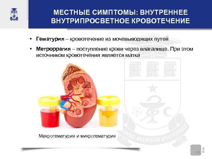 МЕСТНЫЕ СИМПТОМЫ: ВНУТРЕННЕЕ ВНУТРИПРОСВЕТНОЕ КРОВОТЕЧЕНИЕ • Гематурия – кровотечение из мочевыводящих путей • Метроррагия