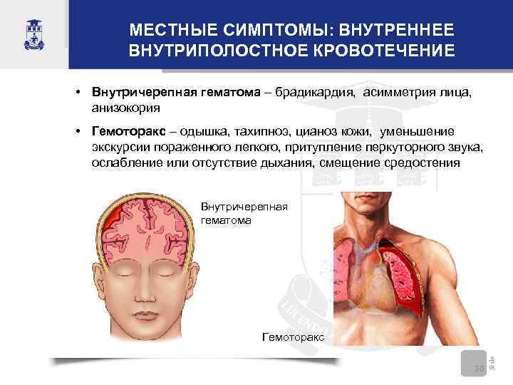 МЕСТНЫЕ СИМПТОМЫ: ВНУТРЕННЕЕ ВНУТРИПОЛОСТНОЕ КРОВОТЕЧЕНИЕ • Внутричерепная гематома – брадикардия, асимметрия лица, анизокория •