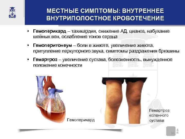 МЕСТНЫЕ СИМПТОМЫ: ВНУТРЕННЕЕ ВНУТРИПОЛОСТНОЕ КРОВОТЕЧЕНИЕ • Гемоперикард – тахикардия, снижение АД, цианоз, набухание шейных