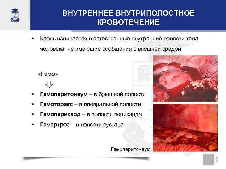 ВНУТРЕННЕЕ ВНУТРИПОЛОСТНОЕ КРОВОТЕЧЕНИЕ • Кровь изливается в естественные внутренние полости тела человека, не имеющие