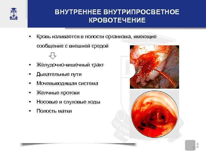 ВНУТРЕННЕЕ ВНУТРИПРОСВЕТНОЕ КРОВОТЕЧЕНИЕ • Кровь изливается в полости организма, имеющие сообщение с внешней средой