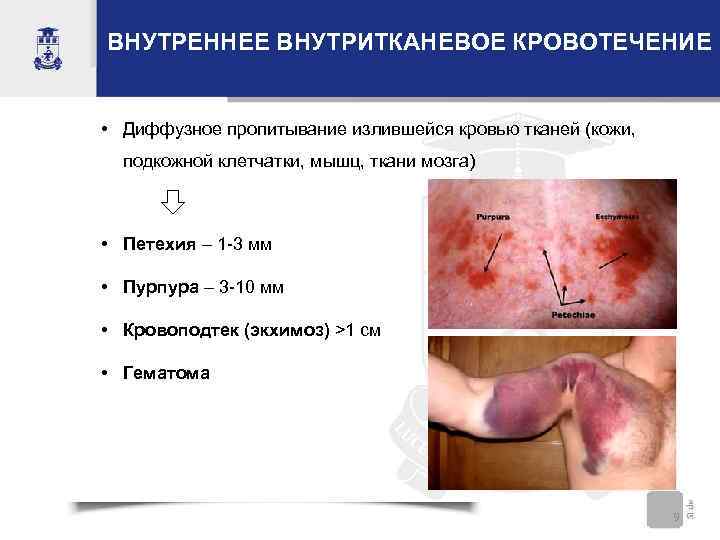 ВНУТРЕННЕЕ ВНУТРИТКАНЕВОЕ КРОВОТЕЧЕНИЕ • Диффузное пропитывание излившейся кровью тканей (кожи, подкожной клетчатки, мышц, ткани