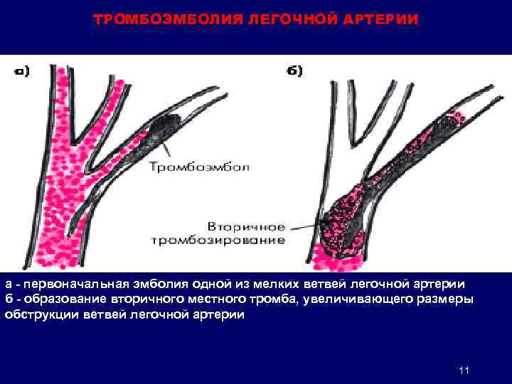 Тромбоэмболия артерий конечностей. Эмболия мелких ветвей легочной артерии.