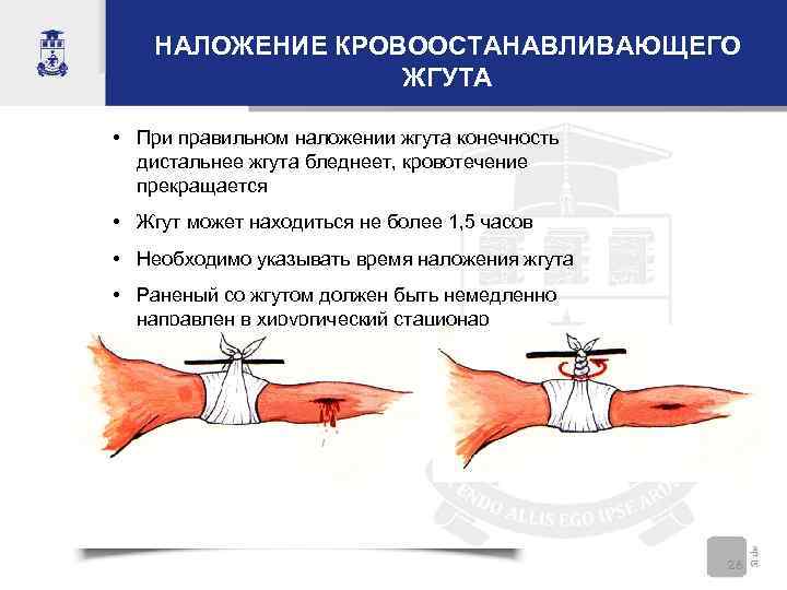 НАЛОЖЕНИЕ КРОВООСТАНАВЛИВАЮЩЕГО ЖГУТА • При правильном наложении жгута конечность дистальнее жгута бледнеет, кровотечение прекращается