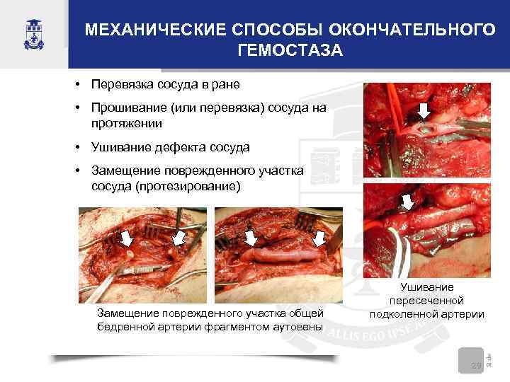 МЕХАНИЧЕСКИЕ СПОСОБЫ ОКОНЧАТЕЛЬНОГО ГЕМОСТАЗА • Перевязка сосуда в ране • Прошивание (или перевязка) сосуда