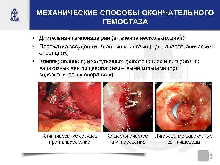 МЕХАНИЧЕСКИЕ СПОСОБЫ ОКОНЧАТЕЛЬНОГО ГЕМОСТАЗА • Длительная тампонада ран (в течение нескольких дней) • Пережатие