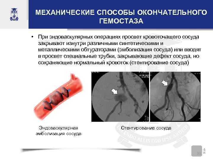 МЕХАНИЧЕСКИЕ СПОСОБЫ ОКОНЧАТЕЛЬНОГО ГЕМОСТАЗА • При эндоваскулярных операциях просвет кровоточащего сосуда закрывают изнутри различными