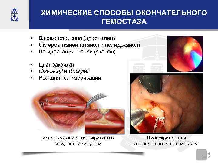 ХИМИЧЕСКИЕ СПОСОБЫ ОКОНЧАТЕЛЬНОГО ГЕМОСТАЗА • • • Вазоконстрикция (адреналин) Склероз тканей (этанол и полидоканол)