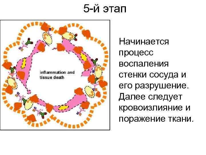 5 -й этап Начинается процесс воспаления стенки сосуда и его разрушение. Далее следует кровоизлияние