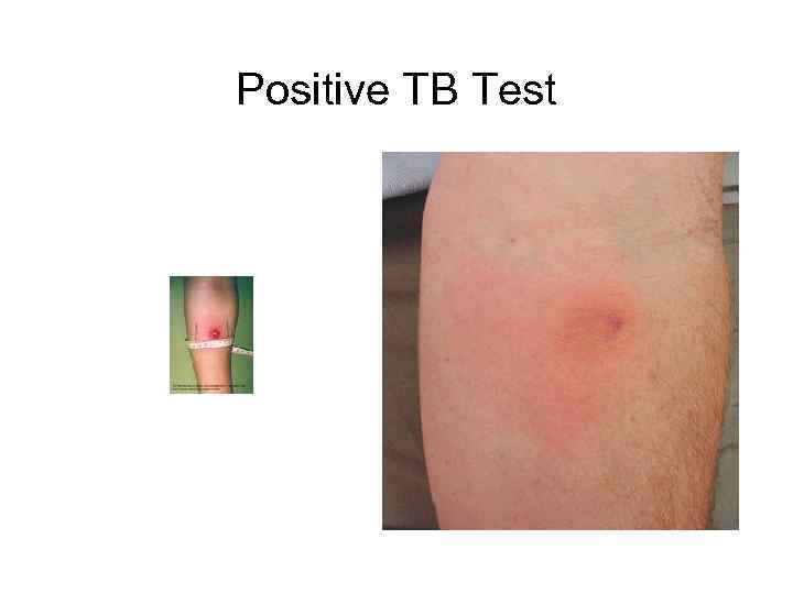 Positive TB Test 