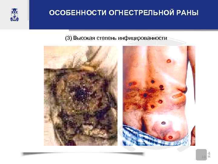 ОСОБЕННОСТИ ОГНЕСТРЕЛЬНОЙ РАНЫ (3) Высокая степень инфицированности 10 